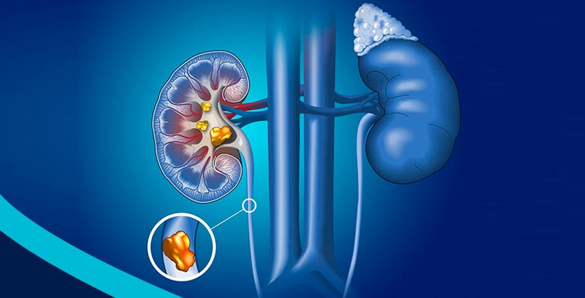 Existe tendência GENÉTICA para formar cálculos renais?