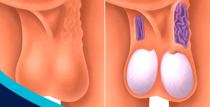 Varicocele: o que é, sintomas,  tratamento e complicações