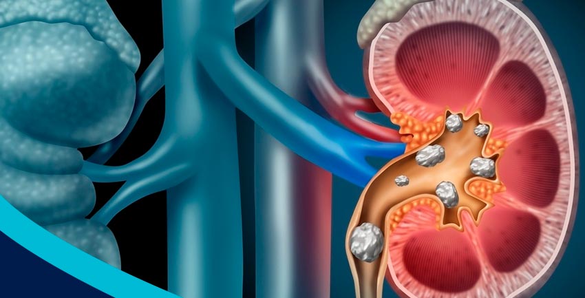 Cálculo Renal: Quanto tempo leva para ele se formar?