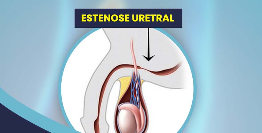 Você sabe o que é a Estenose Uretral?