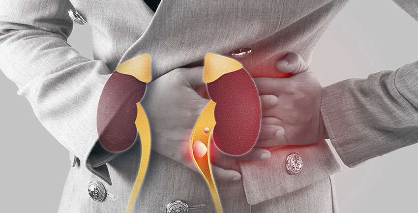 4 medidas importantes que ajudam a prevenir o cálculo renal